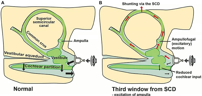 Ilustração anatômica: Aqueduto do vestíbulo (Vestibular Aqueduct)