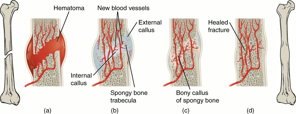 Ilustração anatômica: Calo ósseo (Bony Callus)