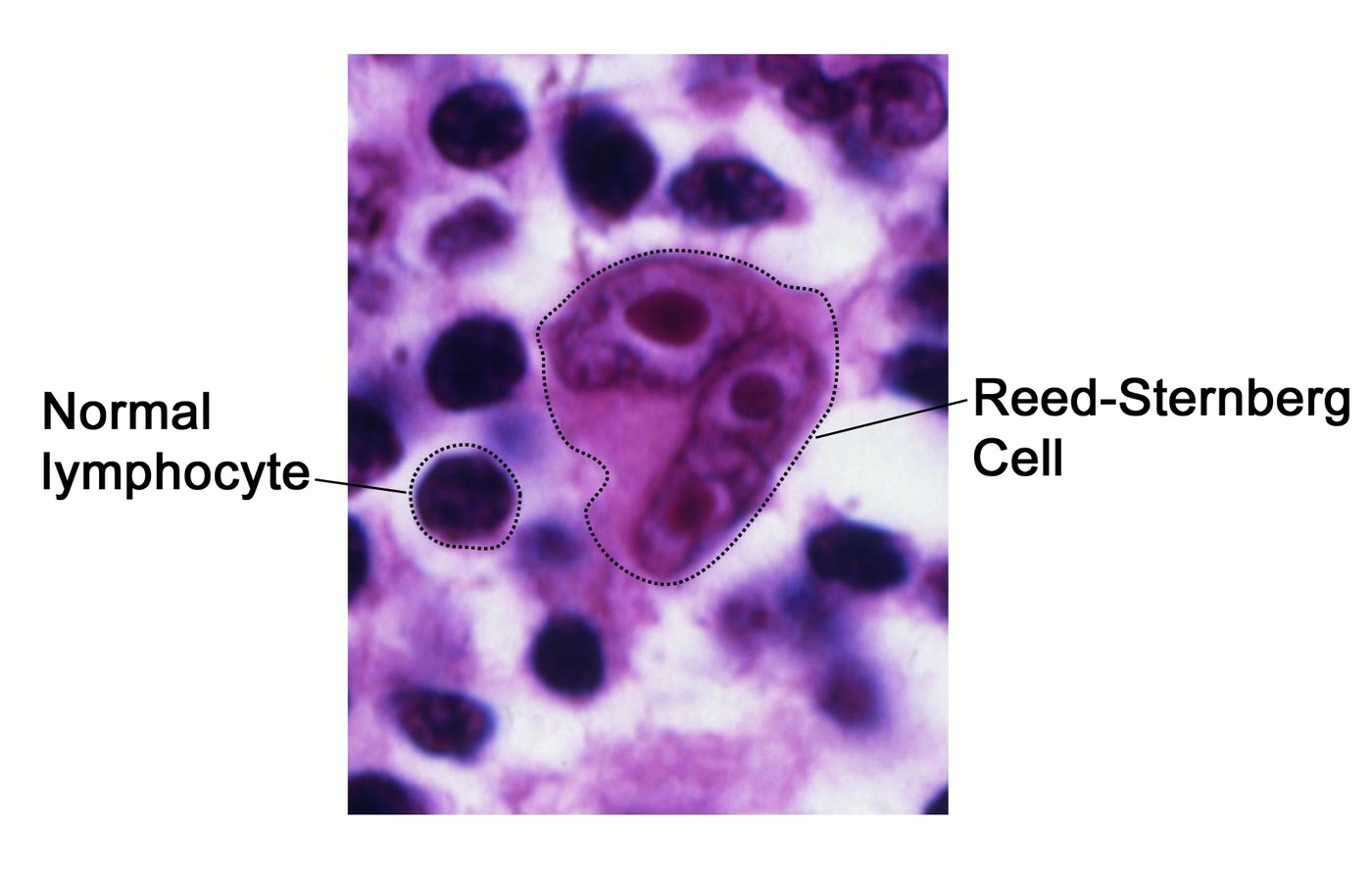 Ilustração anatômica: Célula de Reed-Sternberg (Reed-Sternberg Cells)