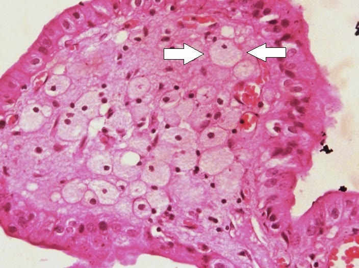 Ilustração anatômica: Célula espumosa (Foam Cells)