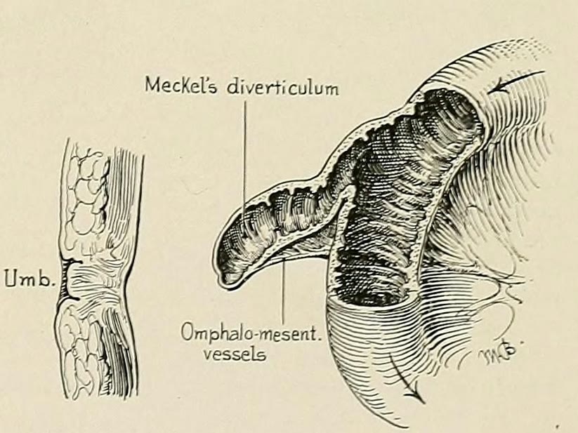 Desenho antigo de um segmento de intestino delgado aberto, com o divertículo de Meckel saindo da parede e os vasos onfalomesentéricos indicados