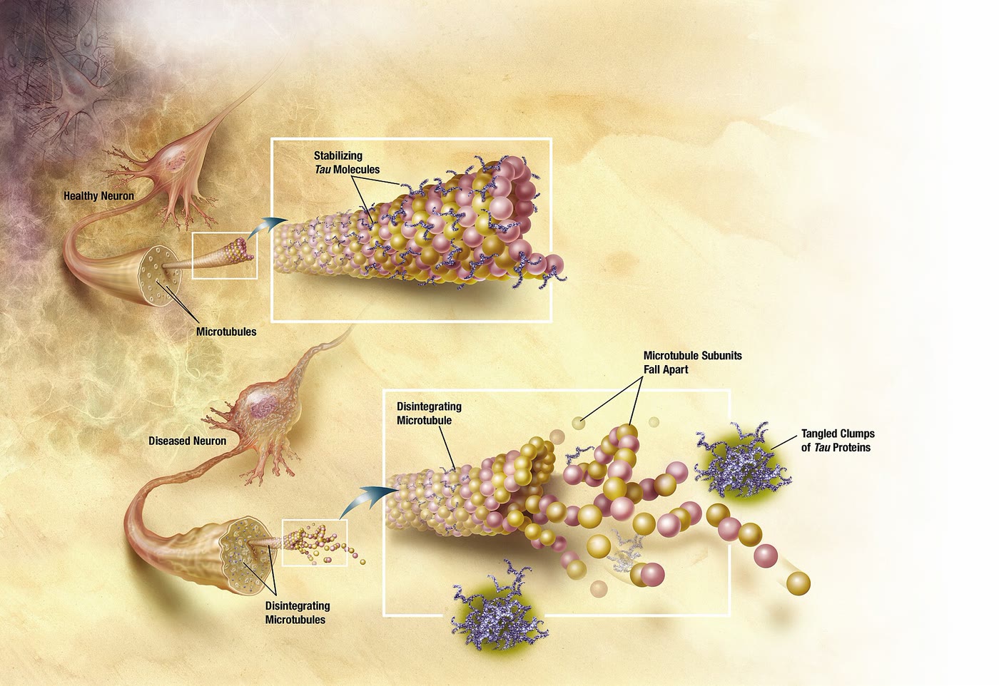 Ilustração anatômica: Emaranhado neurofibrilar (Neurofibrillary Tangles)