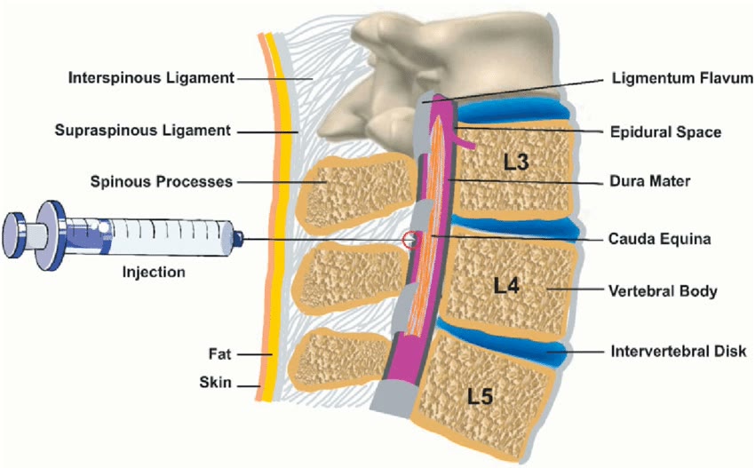 Ilustração anatômica: Espaço epidural (Epidural Space)