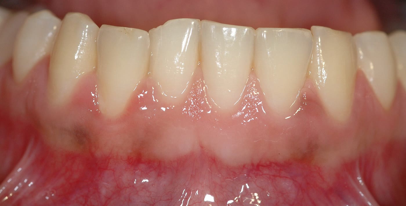 Fotografia de gengiva saudável ao redor dos dentes inferiores