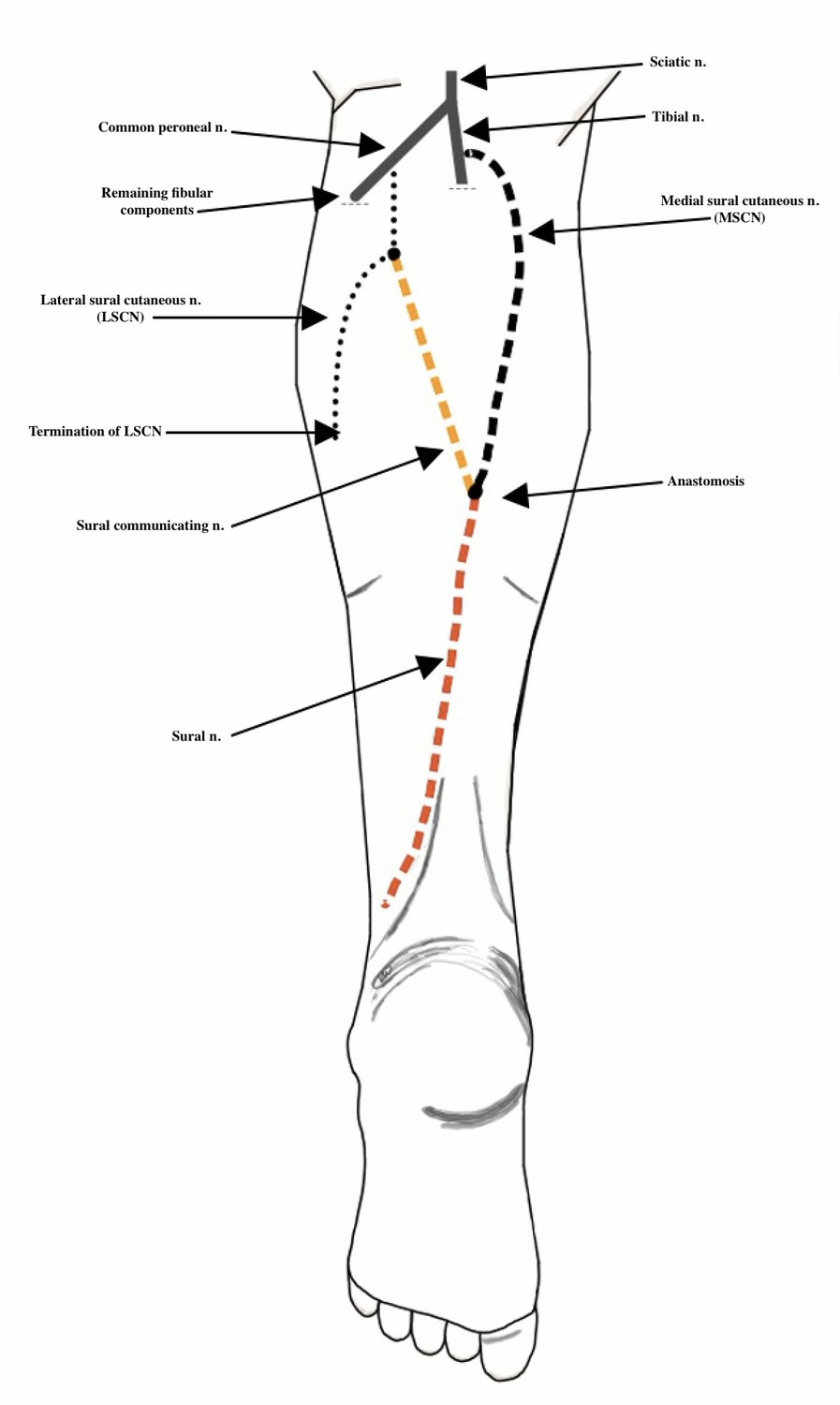 Ilustração anatômica: Nervo sural (Sural Nerve)