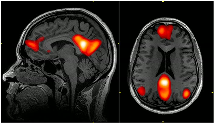 Ilustração anatômica: Rede de modo padrão (Default Mode Network)