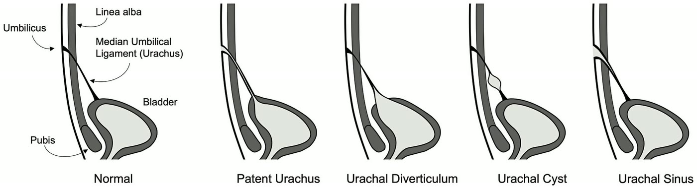 Ilustração anatômica: Úraco (Urachus)