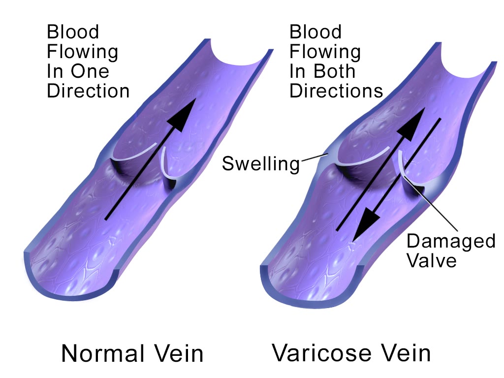 Ilustração anatômica: Valvas venosas (Venous Valves)